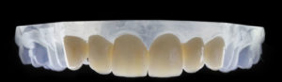 Las coronas dentales de zirconio son más ligeras que las de metal porcelana