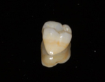 Corona en Zirconio con ajustes de color para semejar a los demás dientes