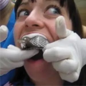 se introduce en la boca del paciente hasta que endurezca, con esto se forma un molde del cual se fabrica un modelo de la boca