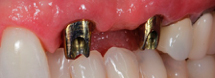 Postes sobre implantes dentales