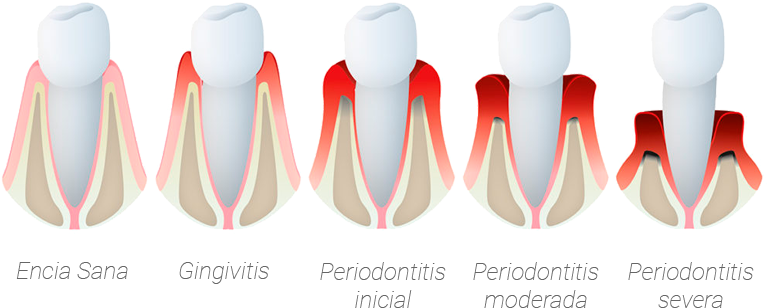 Cómo Prevenir la Enfermedad Periodontal: Gingivitis y Periodontitis