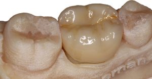 se juega con los tonos “maquillaje de la restauración” para que quede lo más parecido posible al resto de piezas dentales de la boca del paciente