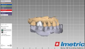 En el laboratorio se procede al diseño digital de la corona u otra restauración, con la cual se rehabilitará la pieza dental