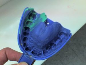 El primer paso para la fabricación de cualquier restauración dental es obtener un duplicado de la boca